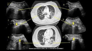 Ecografia Pulmonar en Triage Respiratorio [upl. by Einahc]