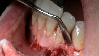 Atlanta Periodontist Georgia GA Cyst Removal Bone Grafting Surgery [upl. by Guidotti]