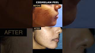 LOOK AT OUR COSMELAN PEEL RESULTS 🤩  Remove Hyperpigmentation Sun Damage amp Dark Spots [upl. by Htial]