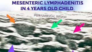 Mesenteric Lymphadenitis in Children  Lymphadenopathy on Ultrasound  Pain Abdomen in Children [upl. by Anibur]