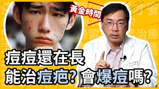 痘疤越早治療越好？痘痘還在長，可以治痘疤？會爆痘嗎？皮膚科林政賢醫師來告訴你把握痘疤治療黃金時間！ [upl. by Ayisan248]