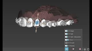 Digitally braces positioning by overlaying STL amp CBCT for very accurate indirect bonding [upl. by Darach364]