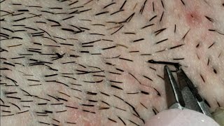 Plucking THICK Beard Hairs Gross and Satisfying [upl. by Hamburger188]