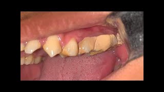 Deep Cleaning With HEAVY Tartar Build Up At The Dentist [upl. by Choo]