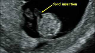 Fetal Medicine Foundation  Fetal anatomy 12 weeks [upl. by Otrebtuc]