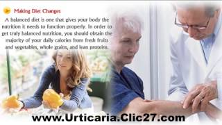 Exercise Induced Urticaria Natural Treatment [upl. by Garlinda]