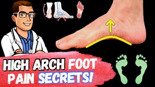 FIX High Arches amp High Arch Feet Supination amp Pes Cavus Foot Type [upl. by Uyerta]