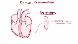 Dilated cardiomyopathy DCM causes symptoms diagnosis treatment amp pathology [upl. by Ecertak]