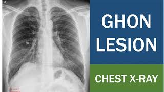 Ghon Lesion  Ghon Focus  Ghon complex  Tuberculoma  Tuberculous Caseating Granuloma  Chest Xray [upl. by Samalla]