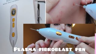 plasma fibroblast pen  alternative to Dermavel  review [upl. by Austen454]