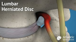 Lumbar Herniated Disc Overview [upl. by Gareth]