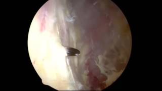 Iliotibial Band Tendinoplasty  ITB Release  ITB Plasty  Hip Surgeon [upl. by Burwell]