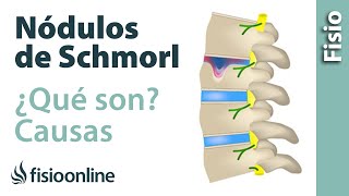 Nódulos de Schmorl  ¿Qué son y cómo sucede [upl. by Idnod]