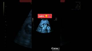 quotUltrasound of Twins at 11 Weeks  Amazing Twin Pregnancy Scanquot [upl. by Anelak]