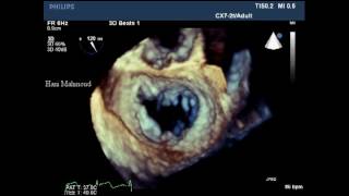 2D3DTEE of Mitral Valve prolapseFlail P1 amp P2 [upl. by Marlene]