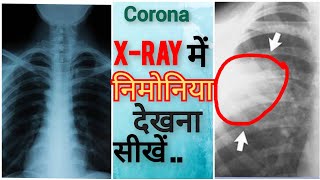 XRAY देखना सीखें  Pneumonia  Read a Chest X ray  Shorts Covid [upl. by Iron]