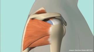 Chronic Subacromial Impingement Animation [upl. by Nylorahs]