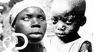 The Eradication Of Smallpox  Invisible Killers [upl. by Higinbotham]