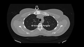 SAPHO syndrome  CT Chest [upl. by Imehon13]