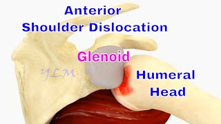 Shoulder Dislocation How To Tell If You Have A Hillsachs Lesion [upl. by Daffie]