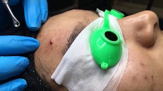 Professional Extractions Facial Lift amp Pump  Blackhead Extraction  Esthetician Training Tutorial [upl. by Bili587]