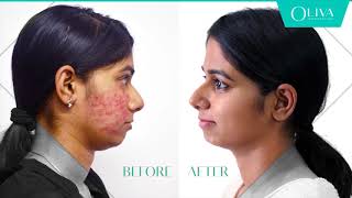 How To Remove Pimples  Professional Treatments For Acne [upl. by Namso]