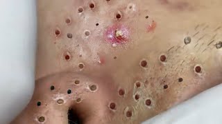 Removal Hidden Blackheads At Loan Nguyen Spa  02 [upl. by Kitrak]