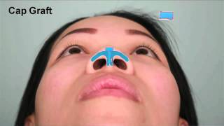 Asian Rhinoplasty Tip Augmentation Case Study Part 2  Dr Thomas Buonassisi 8 West Clinic in BC [upl. by Cesar]