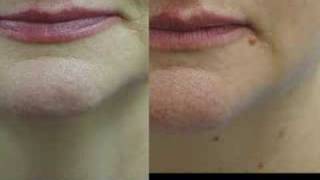 Erbium Laser Resurfacing Before and After Phots [upl. by Imis]