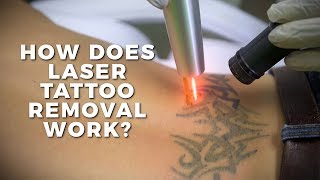 How Does Laser Tattoo Removal Work  Claudio Explains  Body Details [upl. by Jehiel]