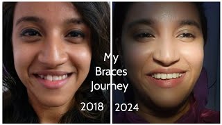 My braces journey in bengali  ceramic braces  Before  After  Is getting braces painful [upl. by Harihs]