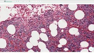 Myelolipoma Adrenal Gland  Histopathology [upl. by Ahdar794]