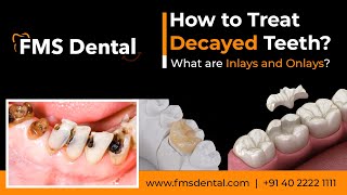 How to Treat Decayed Teeth What are Inlays and Onlays by FMS Dental [upl. by Sherar]