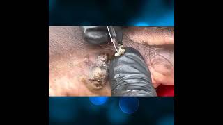 jiggers remove dirty foot [upl. by Atteirneh]