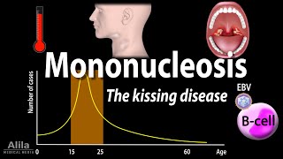 Infectious Mononucleosis Mono  the Kissing Disease Animation [upl. by Willett969]