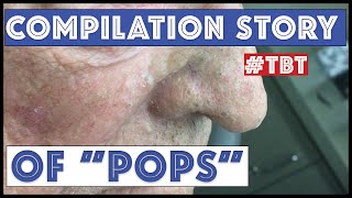 quotPopsquot and his BEST blackhead extractions  TBT [upl. by Elok353]