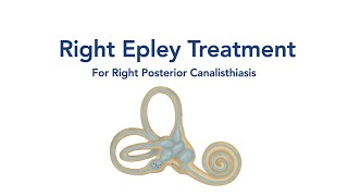 At Home Right Epley Maneuver for BPPV Vertigo [upl. by Itin]