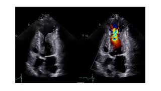 How to Assess the Level of Obstruction with Echocardiography in Patients with HCM [upl. by Chemash]