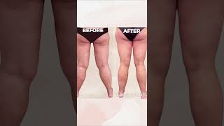 Success of Awake Lipedema Liposuction by Dr Salameh [upl. by Marty]