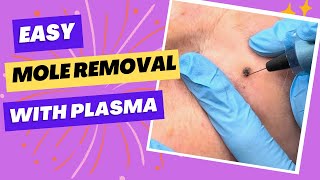 Bye Bye Moles Removal With Plasma Pen [upl. by Aisan]