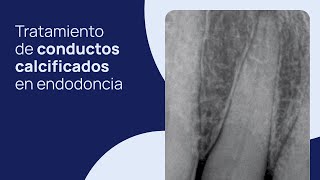 Tratamiento de conductos calcificados en endodoncia cómo instrumentar trucos y consejos personales [upl. by Slinkman]