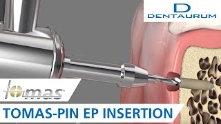 tomas®pin EP Insertion [upl. by Hgielrac954]