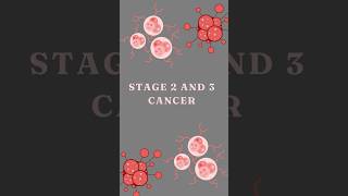 Stage 2 and 3 cancer cancerawareness aiimdelhi oncology shorts [upl. by Mollee]