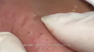 Highlight Professional blackhead popping at its best  GÀ SPA [upl. by Ahseer]