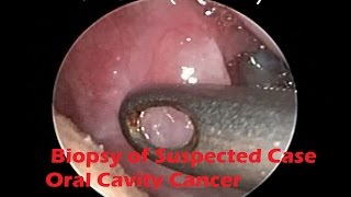 Endoscopic Biopsy of Suspected Case of Oral Cavity Cancer Under LA  SCC [upl. by Debor]