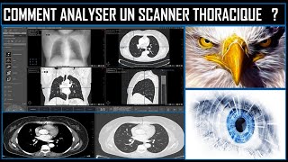 Comment analyser un scanner thoracique [upl. by Tiat]