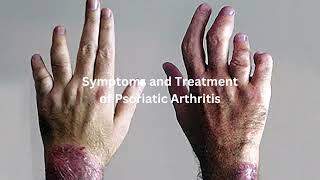 Symptoms and Treatment of Psoriatic Arthritis [upl. by Bej]