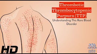 TTP Breakdown A UserFriendly Guide to Thrombotic Thrombocytopenic Purpura [upl. by Hulen]