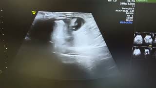 Ultrasound of strangulated umbilical hernia showing omental herniation with fluid [upl. by Airdnazxela]