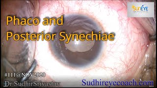 Phaco and Posterior Synechiae  DR SUDHIR SRIVASTAVA [upl. by Akedijn]